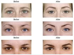 Eye Zone Treatments
