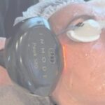Lumecca PEAK Treatment for Roseacia and Pigmentation.