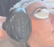Lumecca PEAK Treatment for Roseacia and Pigmentation.